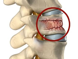 Les causes des maux de dos peuvent être des maladies de la colonne vertébrale et des disques intervertébraux. 