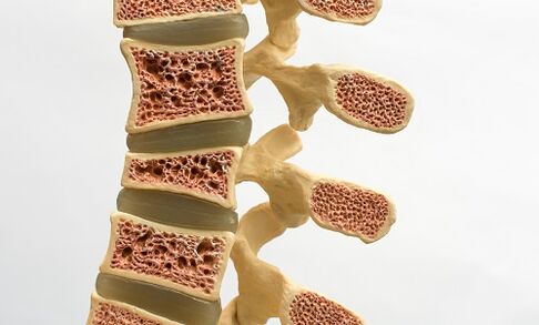 L'ostéoporose est l'une des causes des douleurs lombaires