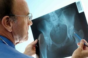Arthrose de l'articulation de la hanche sur la rayon x
