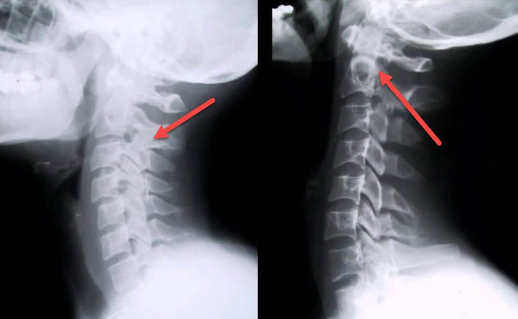 Manifestations d'ostéochondrose de la colonne cervicale à la radiographie