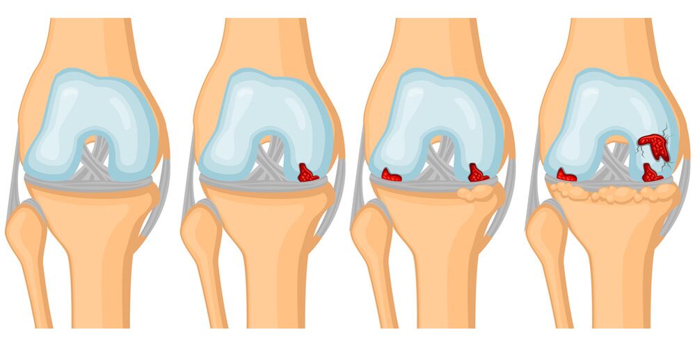 Degré de développement de l'arthrose articulaire