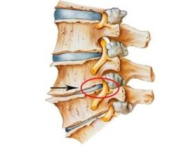 signes et symptômes de l'ostéochondrose